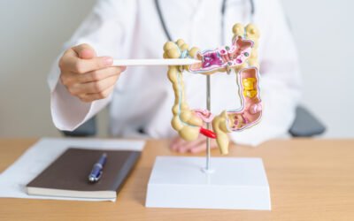 O que é retocolite ulcerativa?